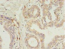 RERG Antibody - Immunohistochemistry of paraffin-embedded human breast cancer using antibody at 1:100 dilution.  This image was taken for the unconjugated form of this product. Other forms have not been tested.