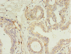 RERG Antibody - Immunohistochemistry of paraffin-embedded human breast cancer using RERG Antibody at dilution of 1:100