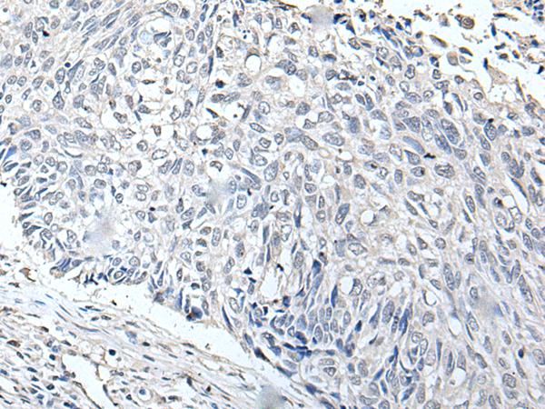 RERG Antibody - Immunohistochemistry of paraffin-embedded Human lung cancer tissue  using RERG Polyclonal Antibody at dilution of 1:65(×200)