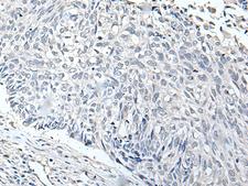 RERG Antibody - Immunohistochemistry of paraffin-embedded Human lung cancer tissue  using RERG Polyclonal Antibody at dilution of 1:65(×200)