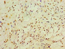 RET Antibody - Immunohistochemistry of paraffin-embedded human breast cancer using antibody at 1:100 dilution.