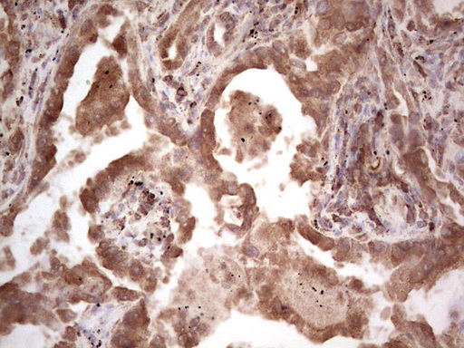 RET Antibody - IHC of paraffin-embedded RET positive Human lung carcinoma tissue using anti-RET mouse monoclonal antibody. (heat-induced epitope retrieval by 1 mM EDTA in 10mM Tris, pH8.5, 120°C for 3min).