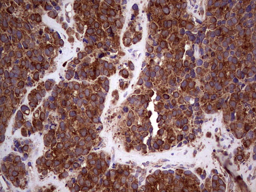 RET Antibody - IHC of paraffin-embedded Carcinoma of RET positive Human lung tissue using anti-RET mouse monoclonal antibody. (Heat-induced epitope retrieval by 1 mM EDTA in 10mM Tris, pH8.5, 120°C for 3min).
