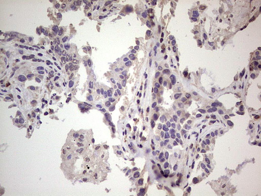 RET Antibody - IHC of paraffin-embedded Carcinoma of RET positive Human lung tissue using anti-RET mouse monoclonal antibody. (Heat-induced epitope retrieval by 1 mM EDTA in 10mM Tris, pH8.5, 120°C for 3min).