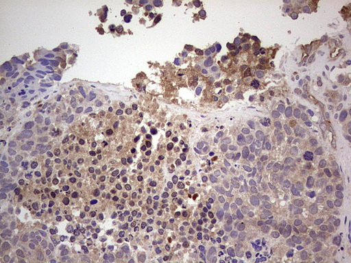 RET Antibody - IHC of paraffin-embedded Carcinoma of RET positive Human lung tissue using anti-RET mouse monoclonal antibody. (Heat-induced epitope retrieval by 1 mM EDTA in 10mM Tris, pH8.5, 120°C for 3min).
