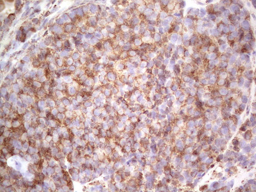 RET Antibody - IHC of paraffin-embedded RET positive Human lung carcinoma tissue using anti-RET mouse monoclonal antibody. (heat-induced epitope retrieval by 1 mM EDTA in 10mM Tris, pH8.5, 120°C for 3min).