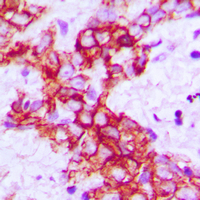 RET Antibody - Immunohistochemical analysis of RET staining in human breast cancer formalin fixed paraffin embedded tissue section. The section was pre-treated using heat mediated antigen retrieval with sodium citrate buffer (pH 6.0). The section was then incubated with the antibody at room temperature and detected using an HRP-conjugated compact polymer system. DAB was used as the chromogen. The section was then counterstained with hematoxylin and mounted with DPX.