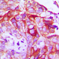 RET Antibody - Immunohistochemical analysis of RET (pY1062) staining in human breast cancer formalin fixed paraffin embedded tissue section. The section was pre-treated using heat mediated antigen retrieval with sodium citrate buffer (pH 6.0). The section was then incubated with the antibody at room temperature and detected using an HRP-conjugated compact polymer system. DAB was used as the chromogen. The section was then counterstained with hematoxylin and mounted with DPX.
