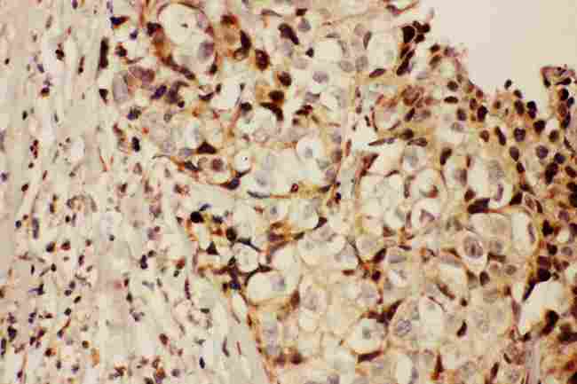 RFC1 / RFC Antibody - IHC analysis of RFC1 using anti-RFC1 antibody. RFC1 was detected in paraffin-embedded section of human mammary cancer tissues. Heat mediated antigen retrieval was performed in citrate buffer (pH6, epitope retrieval solution) for 20 mins. The tissue section was blocked with 10% goat serum. The tissue section was then incubated with 1µg/ml rabbit anti-RFC1 Antibody overnight at 4°C. Biotinylated goat anti-rabbit IgG was used as secondary antibody and incubated for 30 minutes at 37°C. The tissue section was developed using Strepavidin-Biotin-Complex (SABC) with DAB as the chromogen.