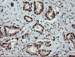 RFC2 / RFC40 Antibody - IHC of paraffin-embedded Carcinoma of Human prostate tissue using anti-RFC2 mouse monoclonal antibody.