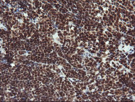 RFC2 / RFC40 Antibody - IHC of paraffin-embedded Human lymphoma tissue using anti-RFC2 mouse monoclonal antibody.