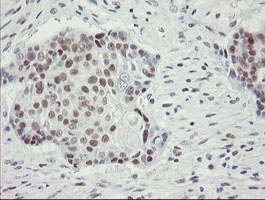 RFC2 / RFC40 Antibody - IHC of paraffin-embedded Carcinoma of Human lung tissue using anti-RFC2 mouse monoclonal antibody.