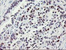 RFC2 / RFC40 Antibody - IHC of paraffin-embedded Adenocarcinoma of Human ovary tissue using anti-RFC2 mouse monoclonal antibody.