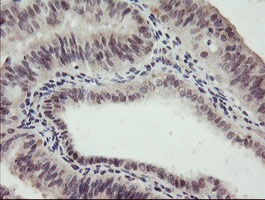 RFC2 / RFC40 Antibody - IHC of paraffin-embedded Adenocarcinoma of Human endometrium tissue using anti-RFC2 mouse monoclonal antibody.