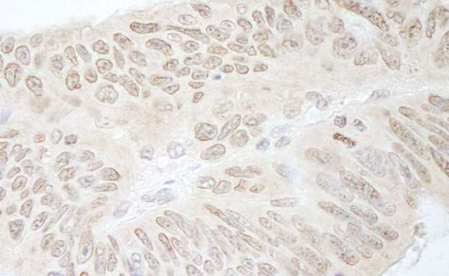 RFC3 Antibody - Detection of Human RFC3 by Immunohistochemistry. Sample: FFPE section of human colon carcinoma. Antibody: Affinity purified rabbit anti-RFC3 used at a dilution of 1:1000 (1 ug/ml). Detection: DAB.