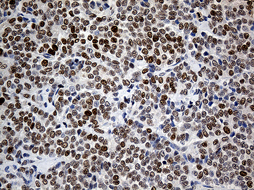 RFC3 Antibody - Immunohistochemical staining of paraffin-embedded Adenocarcinoma of Human breast tissue tissue using anti-RFC3 mouse monoclonal antibody. (Heat-induced epitope retrieval by 1mM EDTA in 10mM Tris buffer. (pH8.5) at 120°C for 3 min. (1:500)
