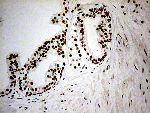 RFC3 Antibody - Immunohistochemical staining of paraffin-embedded Carcinoma of Human prostate tissue using anti-RFC3 mouse monoclonal antibody. (Heat-induced epitope retrieval by 1mM EDTA in 10mM Tris buffer. (pH8.5) at 120°C for 3 min. (1:2000)