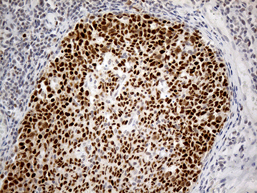 RFC3 Antibody - Immunohistochemical staining of paraffin-embedded Human tonsil within the normal limits using anti-RFC3 mouse monoclonal antibody. (Heat-induced epitope retrieval by 1mM EDTA in 10mM Tris buffer. (pH8.5) at 120°C for 3 min. (1:2000)