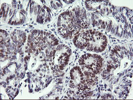 RFC4 Antibody - IHC of paraffin-embedded Carcinoma of Human pancreas tissue using anti-RFC4 mouse monoclonal antibody. (Heat-induced epitope retrieval by 10mM citric buffer, pH6.0, 120°C for 3min).