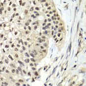 RFC5 Antibody - Immunohistochemistry of paraffin-embedded human lung cancer tissue.