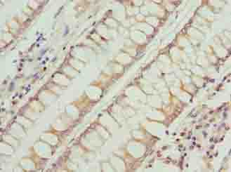 RFESD Antibody - Immunohistochemistry of paraffin-embedded human colon cancer using antibody at dilution of 1:100.