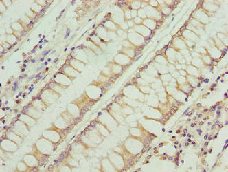 RFESD Antibody - Immunohistochemistry of paraffin-embedded human colon cancer using RFESD Antibody at dilution of 1:100