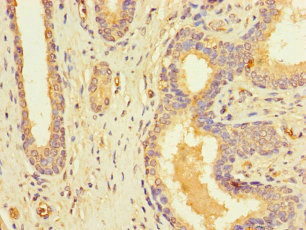 RFK Antibody - Immunohistochemistry of paraffin-embedded human prostate cancer using RFK Antibody at dilution of 1:100