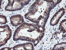 RFPL3 Antibody - IHC of paraffin-embedded Adenocarcinoma of Human colon tissue using anti-RFPL3 mouse monoclonal antibody.
