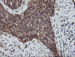 RFPL3 Antibody - IHC of paraffin-embedded Adenocarcinoma of Human ovary tissue using anti-RFPL3 mouse monoclonal antibody.
