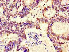 RFPL4B Antibody - Immunohistochemistry of paraffin-embedded human colon cancer using RFPL4B Antibody at dilution of 1:100