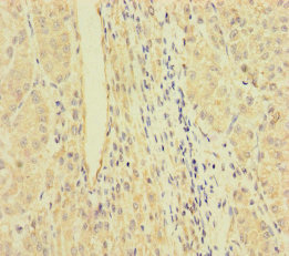 RFTN2 Antibody - Immunohistochemistry of paraffin-embedded human liver cancer using RFTN2 Antibody at dilution of 1:100