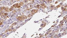 RFTN2 Antibody - 1:100 staining human liver carcinoma tissues by IHC-P. The sample was formaldehyde fixed and a heat mediated antigen retrieval step in citrate buffer was performed. The sample was then blocked and incubated with the antibody for 1.5 hours at 22°C. An HRP conjugated goat anti-rabbit antibody was used as the secondary.