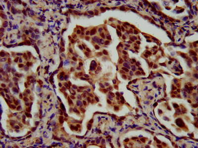 RFX / RFX1 Antibody - Immunohistochemistry image at a dilution of 1:700 and staining in paraffin-embedded human lung cancer performed on a Leica BondTM system. After dewaxing and hydration, antigen retrieval was mediated by high pressure in a citrate buffer (pH 6.0) . Section was blocked with 10% normal goat serum 30min at RT. Then primary antibody (1% BSA) was incubated at 4 °C overnight. The primary is detected by a biotinylated secondary antibody and visualized using an HRP conjugated SP system.