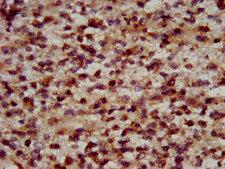 RFX2 Antibody - IHC image of RFX2 Antibody diluted at 1:600 and staining in paraffin-embedded human glioma performed on a Leica BondTM system. After dewaxing and hydration, antigen retrieval was mediated by high pressure in a citrate buffer (pH 6.0). Section was blocked with 10% normal goat serum 30min at RT. Then primary antibody (1% BSA) was incubated at 4°C overnight. The primary is detected by a biotinylated secondary antibody and visualized using an HRP conjugated SP system.