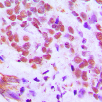 RFX3 Antibody - Immunohistochemical analysis of RFX3 staining in human breast cancer formalin fixed paraffin embedded tissue section. The section was pre-treated using heat mediated antigen retrieval with sodium citrate buffer (pH 6.0). The section was then incubated with the antibody at room temperature and detected using an HRP conjugated compact polymer system. DAB was used as the chromogen. The section was then counterstained with hematoxylin and mounted with DPX.