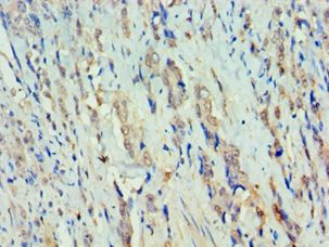 RFX5 Antibody - Immunohistochemistry of paraffin-embedded human rectal cancer using antibody at 1:100 dilution.