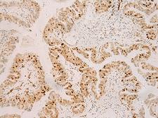 RFX6 Antibody - Immunohistochemistry of paraffin-embedded Human liver cancer tissue  using RFX6 Polyclonal Antibody at dilution of 1:50(×200)