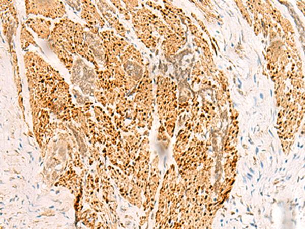 RFX6 Antibody - Immunohistochemistry of paraffin-embedded Human esophagus cancer tissue  using RFX6 Polyclonal Antibody at dilution of 1:50(×200)