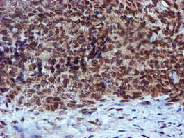 RFXANK Antibody - IHC of paraffin-embedded Adenocarcinoma of Human breast tissue using anti-RFXANK mouse monoclonal antibody.