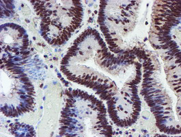 RFXANK Antibody - IHC of paraffin-embedded Adenocarcinoma of Human colon tissue using anti-RFXANK mouse monoclonal antibody.