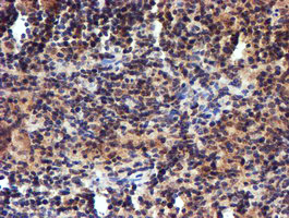 RFXANK Antibody - IHC of paraffin-embedded Human lymphoma tissue using anti-RFXANK mouse monoclonal antibody.