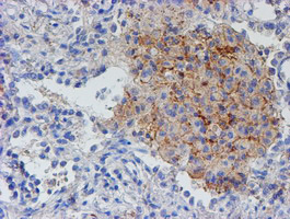 RFXANK Antibody - IHC of paraffin-embedded Carcinoma of Human lung tissue using anti-RFXANK mouse monoclonal antibody.
