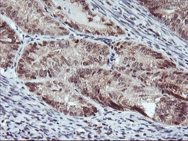RFXANK Antibody - IHC of paraffin-embedded Adenocarcinoma of Human endometrium tissue using anti-RFXANK mouse monoclonal antibody.