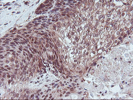 RFXANK Antibody - IHC of paraffin-embedded Carcinoma of Human bladder tissue using anti-RFXANK mouse monoclonal antibody.