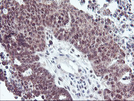 RFXANK Antibody - IHC of paraffin-embedded Adenocarcinoma of Human ovary tissue using anti-RFXANK mouse monoclonal antibody.