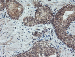 RFXANK Antibody - IHC of paraffin-embedded Carcinoma of Human prostate tissue using anti-RFXANK mouse monoclonal antibody.