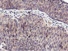 RFXANK Antibody - IHC of paraffin-embedded Carcinoma of Human bladder tissue using anti-RFXANK mouse monoclonal antibody.