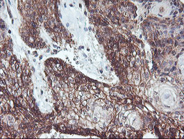 RFXANK Antibody - IHC of paraffin-embedded Carcinoma of Human bladder tissue using anti-RFXANK mouse monoclonal antibody. (Heat-induced epitope retrieval by 10mM citric buffer, pH6.0, 100C for 10min).