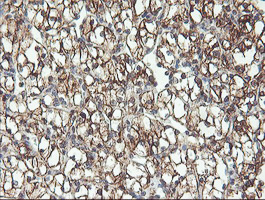 RFXANK Antibody - IHC of paraffin-embedded Carcinoma of Human kidney tissue using anti-RFXANK mouse monoclonal antibody. (Heat-induced epitope retrieval by 10mM citric buffer, pH6.0, 100C for 10min).