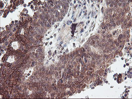 RFXANK Antibody - IHC of paraffin-embedded Adenocarcinoma of Human ovary tissue using anti-RFXANK mouse monoclonal antibody. (Heat-induced epitope retrieval by 10mM citric buffer, pH6.0, 100C for 10min).
